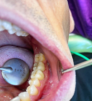 Protesi fissa_edited.jpg