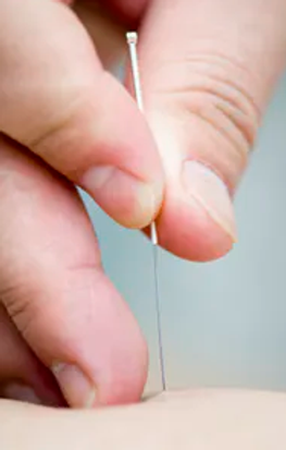 dryNeedling.jpg.webp
