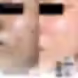 Close‑up of the lower cheek area showing shallow boxcar and rolling acne scars; clinic lighting emphasises skin texture under professional conditions.