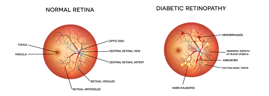 diabetic retinopathy.png