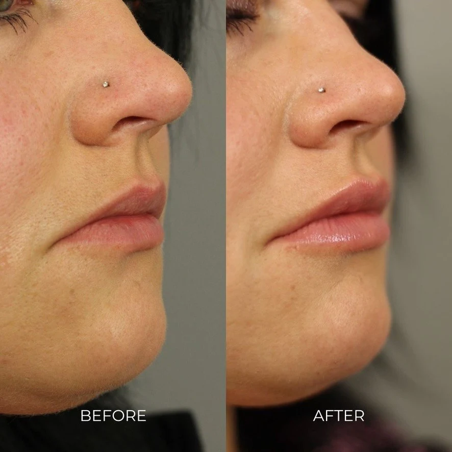 How Often Can You Get Dermal Fillers