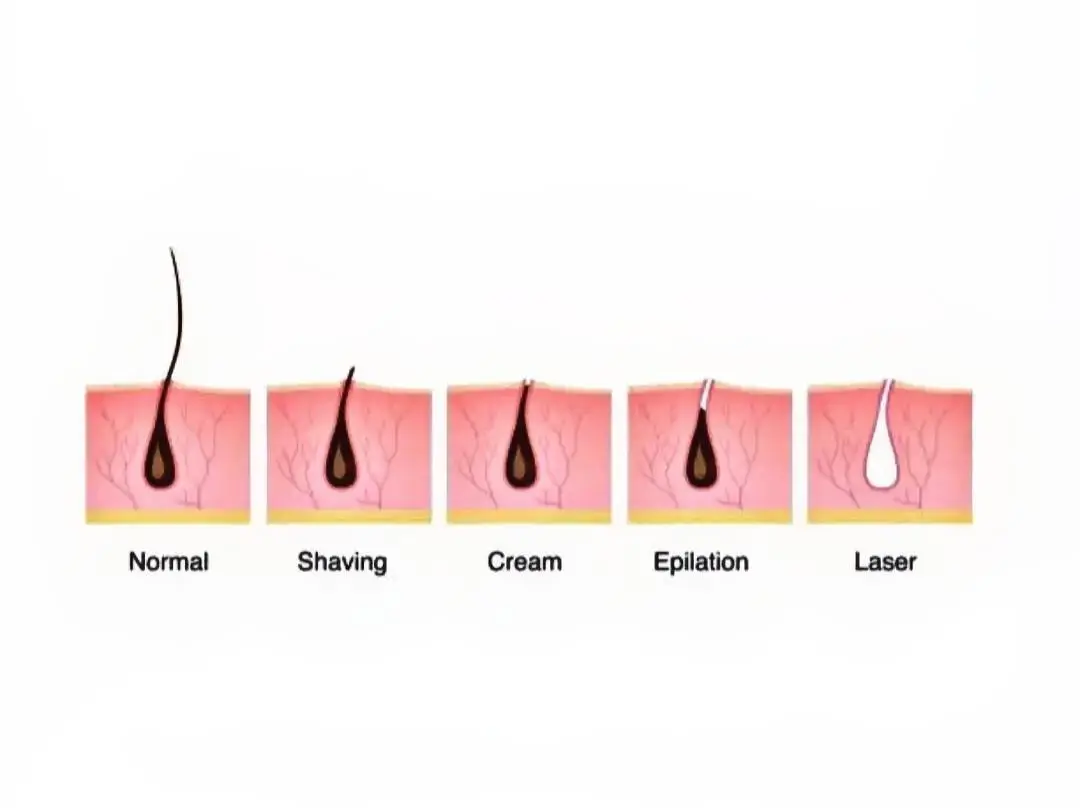 The Cost of Laser Hair Removal In Jeddah