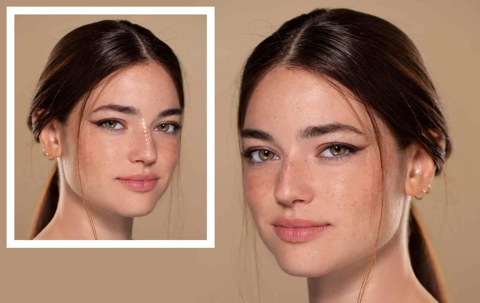 Best Doctor for Under Eye Fillers in Doha, Qatar | Cost Breakdown