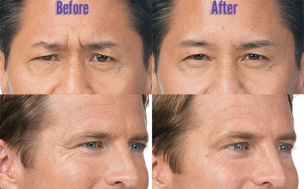 Botox for men: Procedure, Benefits & Side Effects