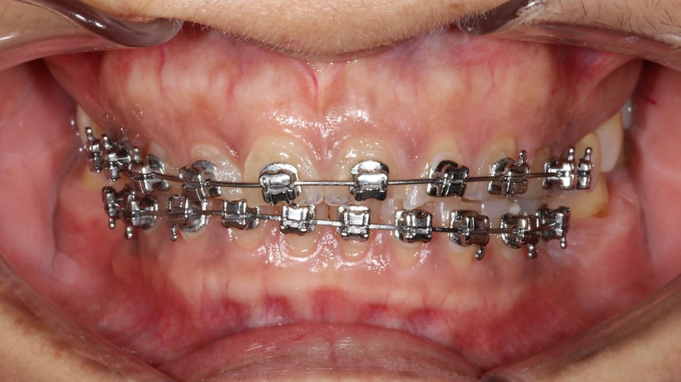 Braces On.jpeg