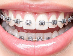 metal spangen speed brackets