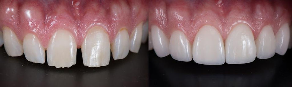 dominican republic dentist veneers before and after.jpeg