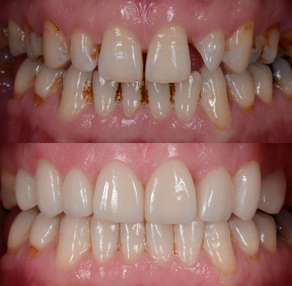 Before and After Porcelain Veneers in Dominican Republic