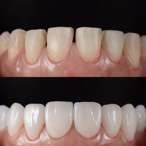 dental veneers specialist in dominican republic.jpeg