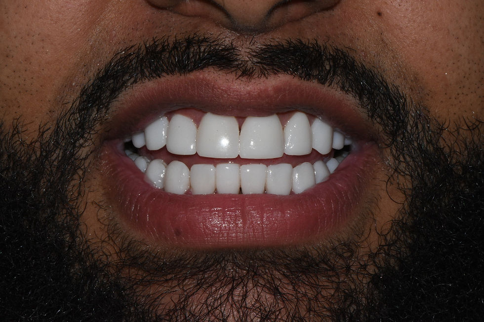 Before and After Porcelain Veneers in Dominican Republic