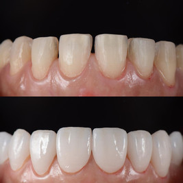 Dominican Veneers Before & After in DR.jpeg