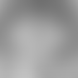 Scleroembolizzazione del varicocele maschile