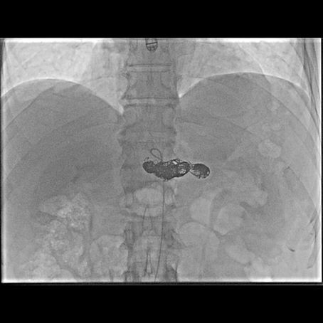 Aneurisma delle arterie viscerali