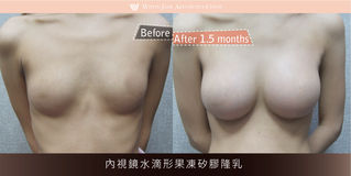 素人05 | 內視鏡水滴形果凍矽膠隆乳