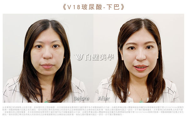2019.07-V18玻尿酸下巴(芸).jpg