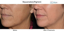 Ultra_Loverme Rejuvenation_Pigment 7 Left close up.jpg