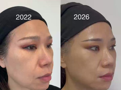 Ultraformer MPT for 50+ Skin: The results speak for Themselves
