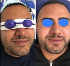 IPL at Bloom Skin and Laser