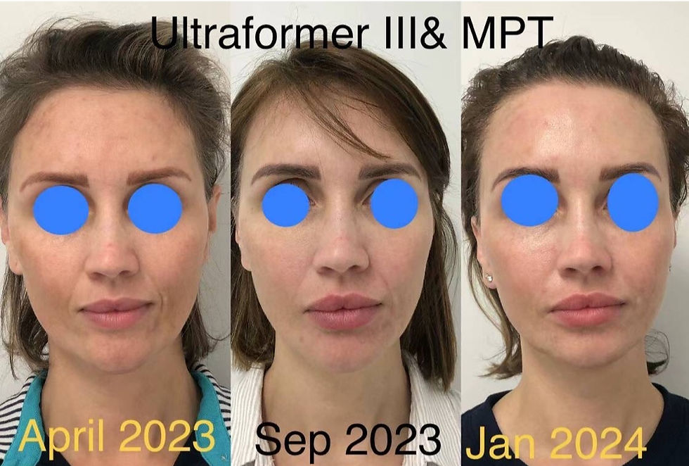 Ultraformer HIFU results different years @ Bloom Skin & Ma