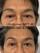 Ultraformer MPTbefore and after Forehead and eyes at Bloom skin & Laser