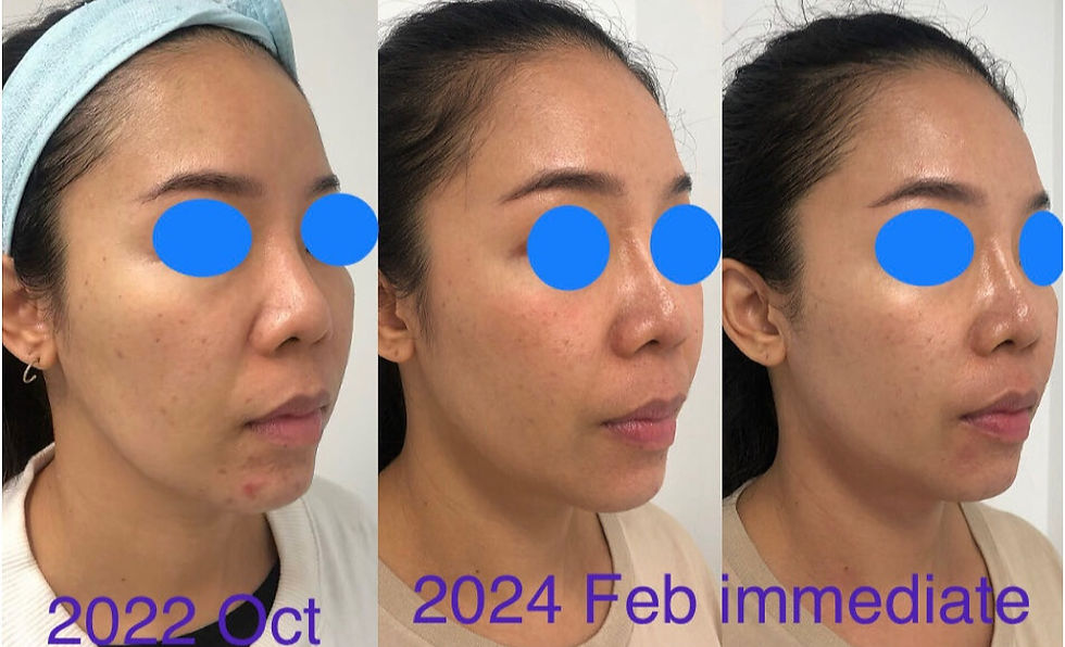 Ultraformer HIFU results in different years @ Bloom Skin & Massage