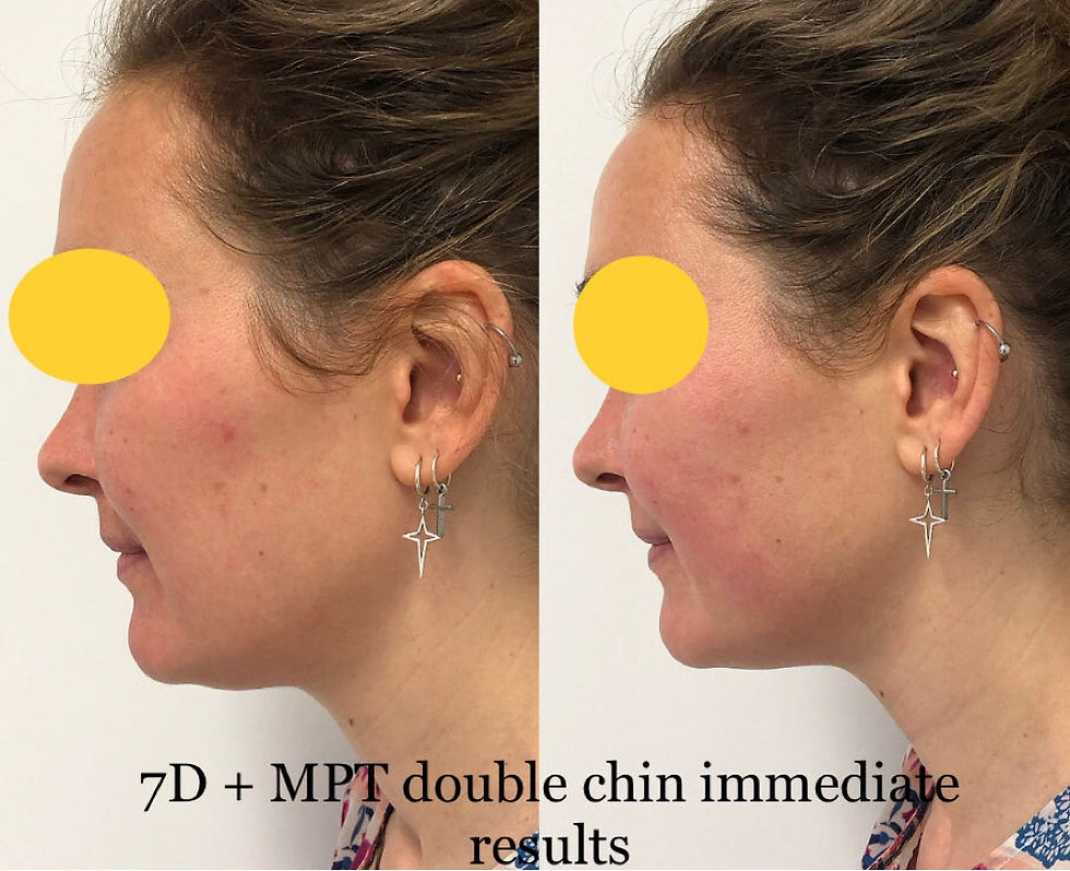 Ultraformer HIFU Double chin immediate results @ Bloom Skin & Massage