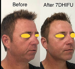 UltraformerIII (7D HIFU) before and straight after@ Bloom Skin & Ma