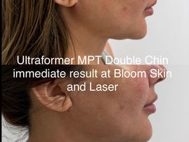 Ultraformer-MPT-double-chin-treatment-Brisbane
