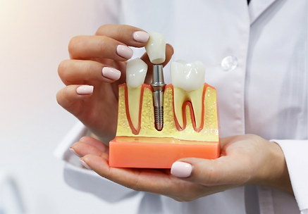 Dental Implants.png