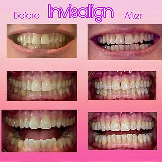 Invisalign 3.jpg