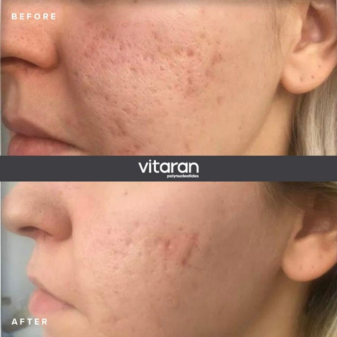 Polynukleotidi hoito