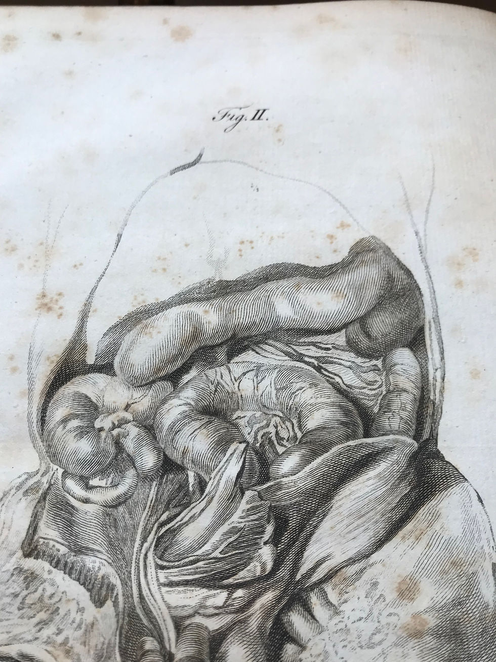 Thumbnail: HUNTER, Medical Commentaries, Second Edition, 1777