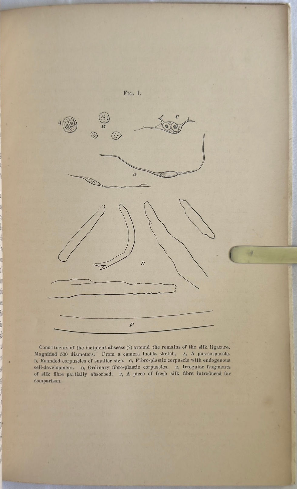 Thumbnail: Lister, Observations on Ligature of Arteries on the Antiseptic System, 1870