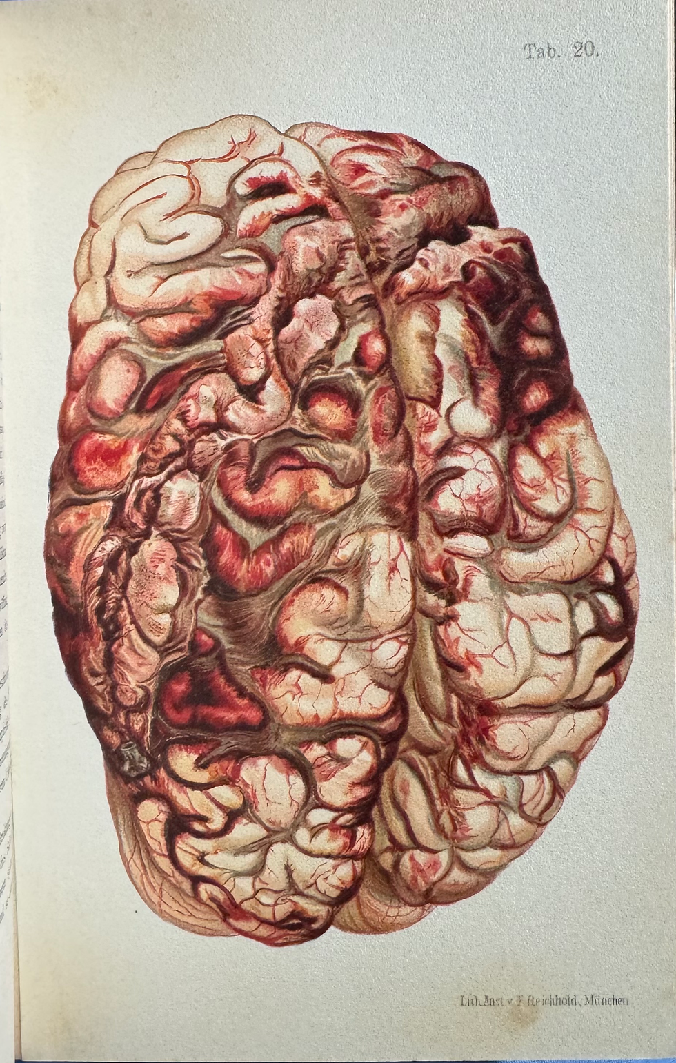 Thumbnail: Hofmann,  Atlas der Gerichtlichen Medizin, 1898 (first edition)