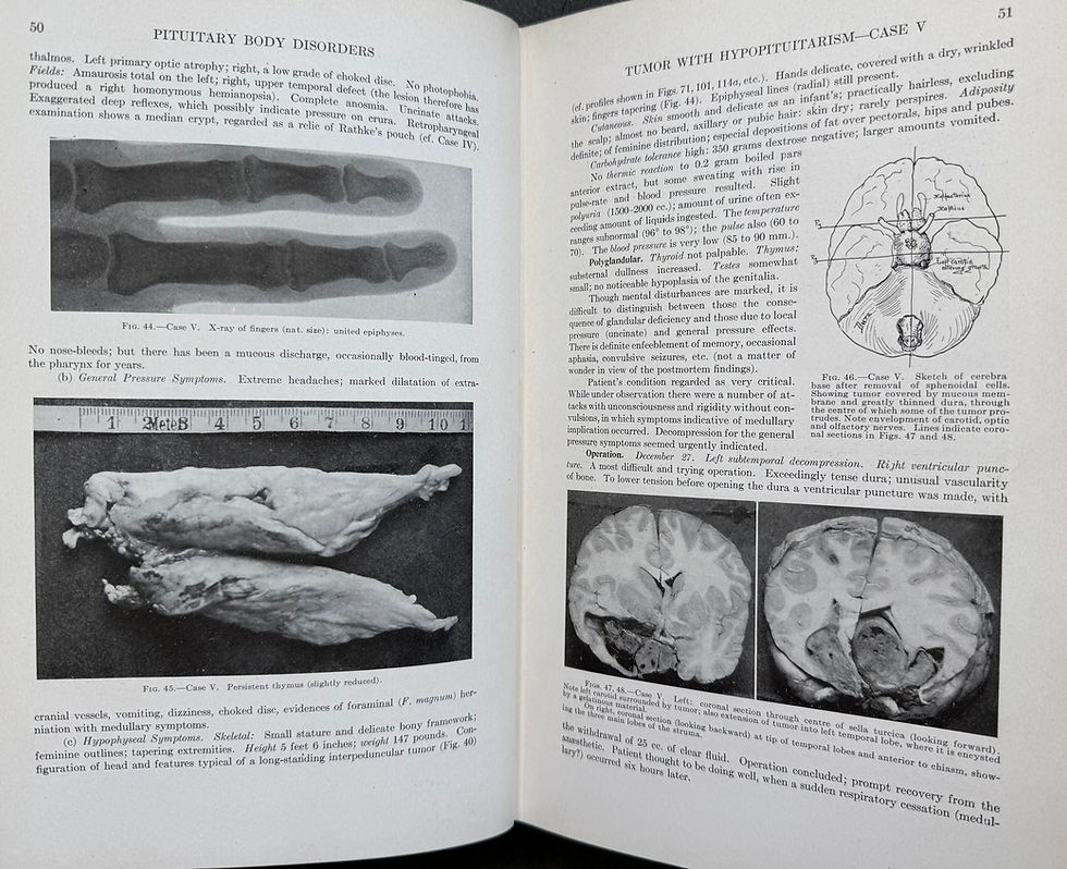 Thumbnail: Cushing, Pituitary, 1912