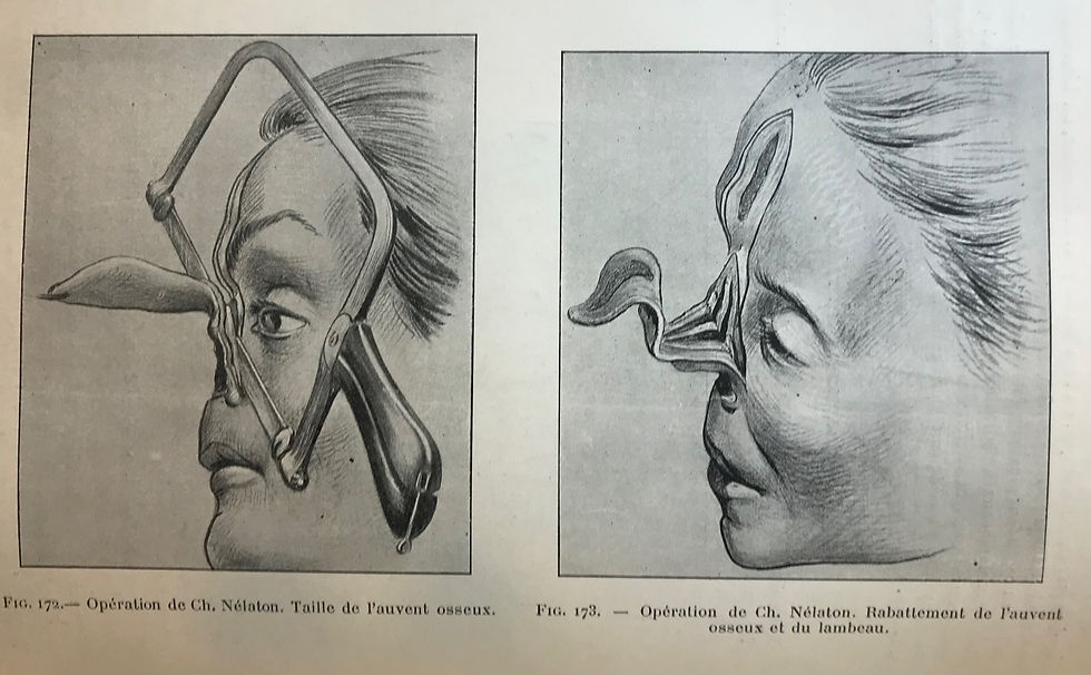 Thumbnail: Nelaton, Traite de Medecine Operatoire et de Therapeutique Chirurgicale, 1904