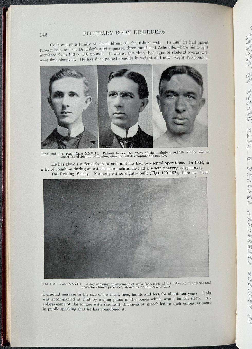 Thumbnail: Cushing, Pituitary Body and its Disorders, 1912