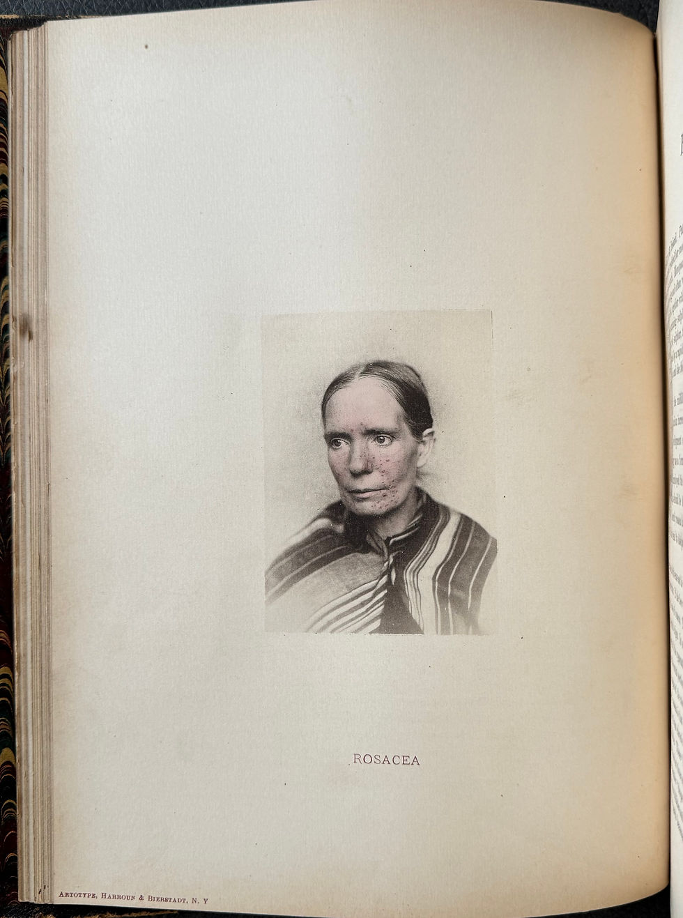 Thumbnail: Fox, Photographic Illustrations of Skin Diseases, 1880