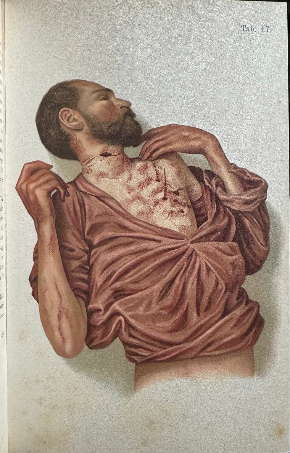 Thumbnail: Hofmann,  Atlas der Gerichtlichen Medizin, 1898 (first edition)