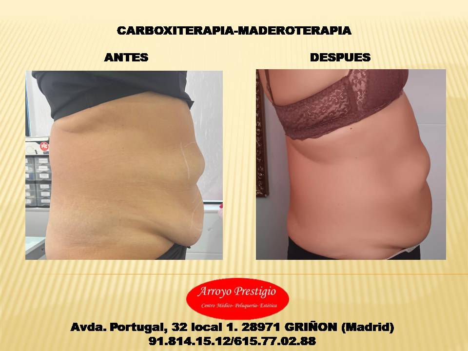 tratamiento reductor reafirmante