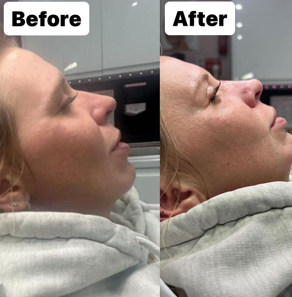 Non-surgical rhinoplasty