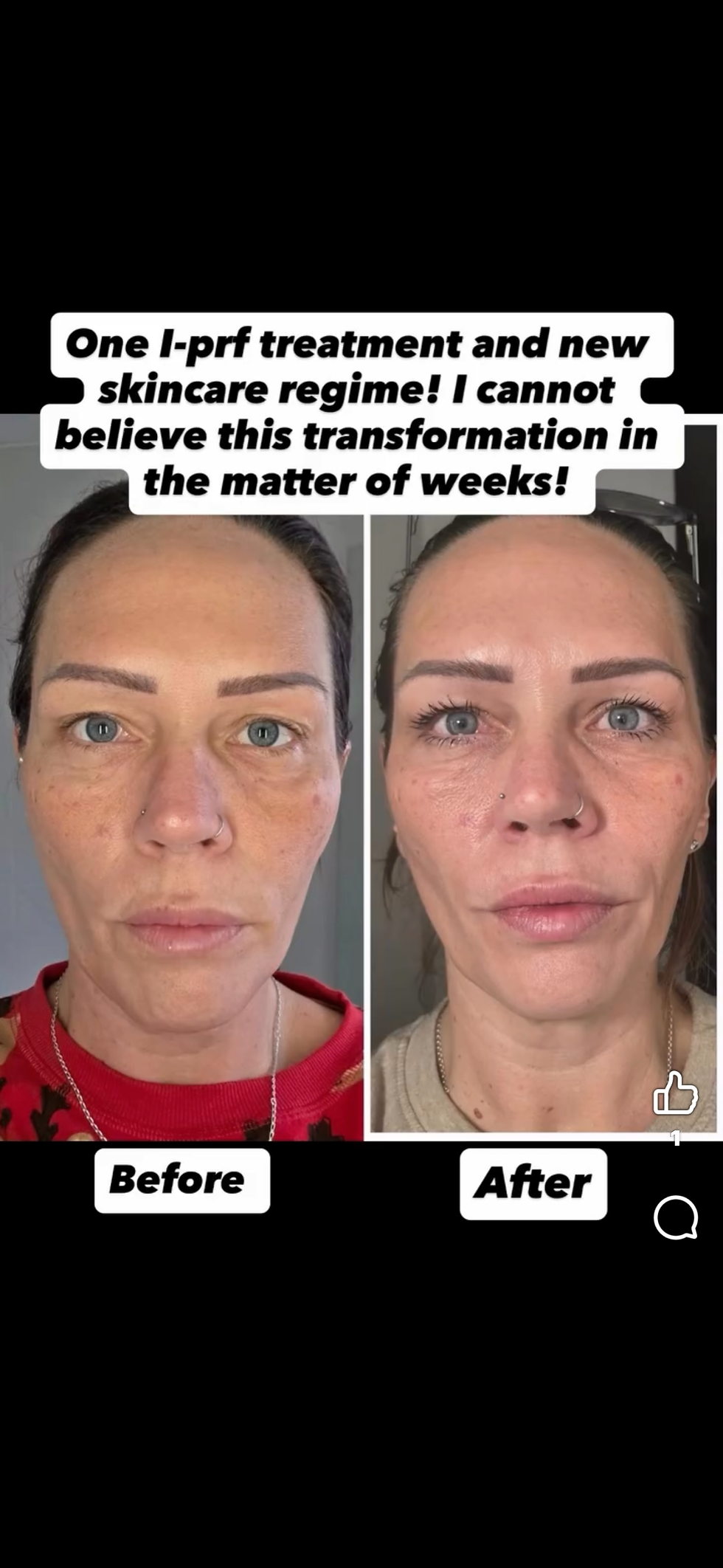 I-prf the next generation prp in essex