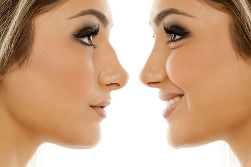 Benefits of a non-surgical rhinoplasty