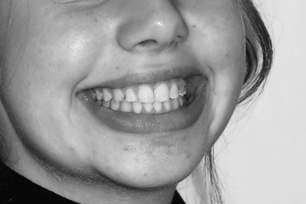 impacted teeth