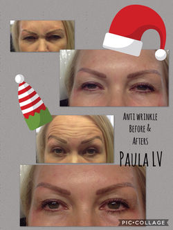 Paula LV Anti-Wrinkle Injections