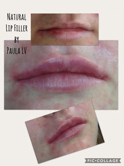 Paula LV Aesthetics Lip Fillers