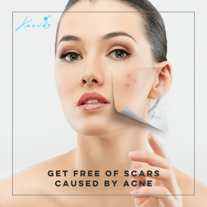 GET FREE OF SCARS CAUSED BY ACNE