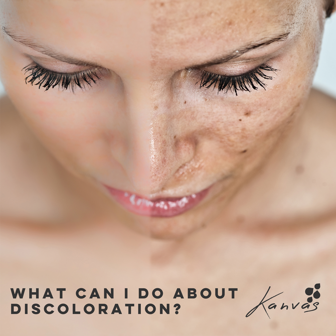 WHAT CAN I DO ABOUT DISCOLORATION?