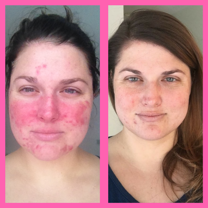 Before and After Skincare Routine