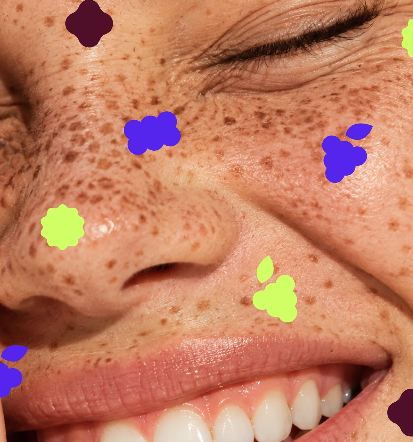 freckles